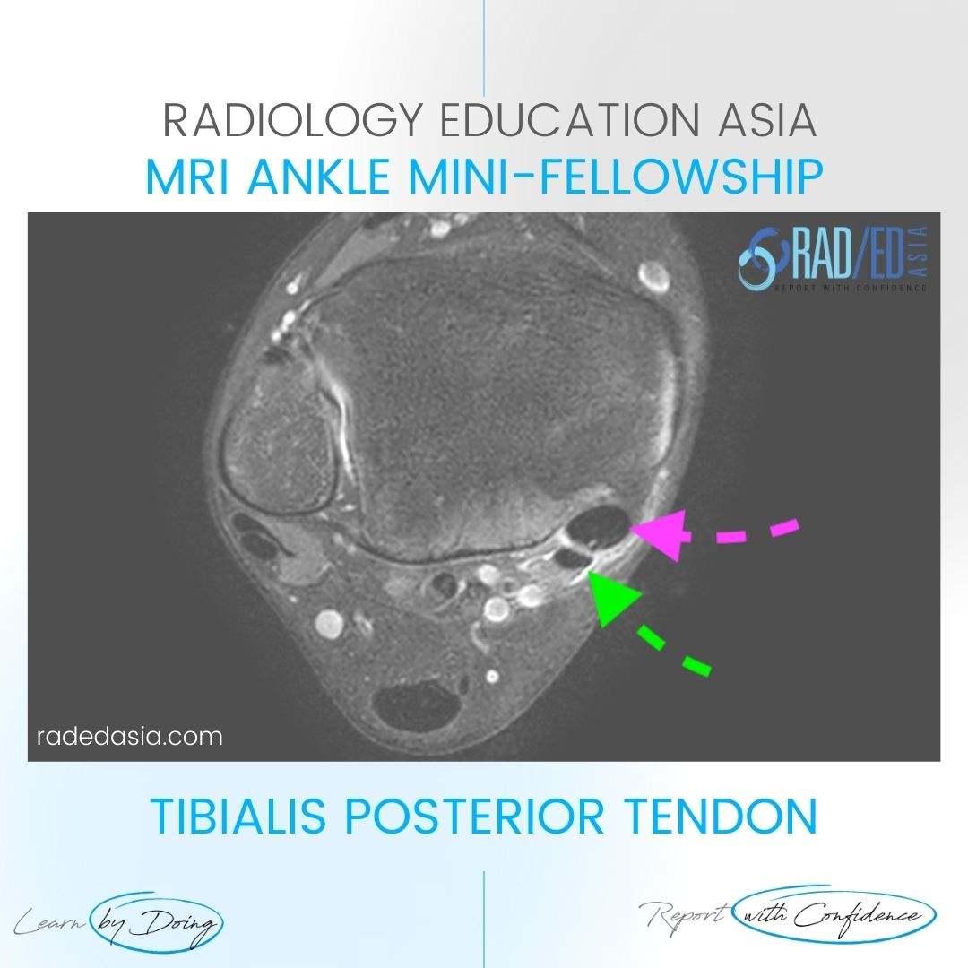 posterior tibial tendinopathy mri radiology radedasia