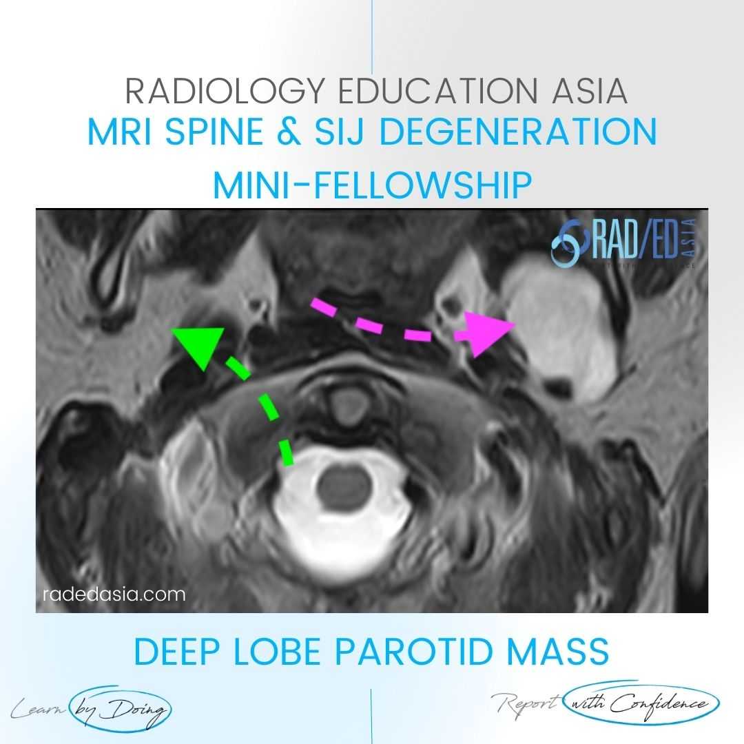 mri spine incidental findings parotid mass