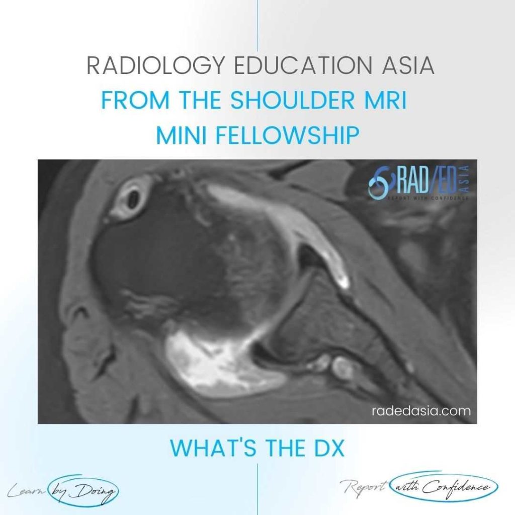 shoulder synovitis mri rheumatoid arthritis subacromaial bursa radedasia