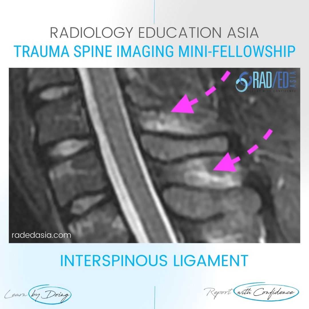 spine ligaments mri injury radiology interspinous trauma radedasia