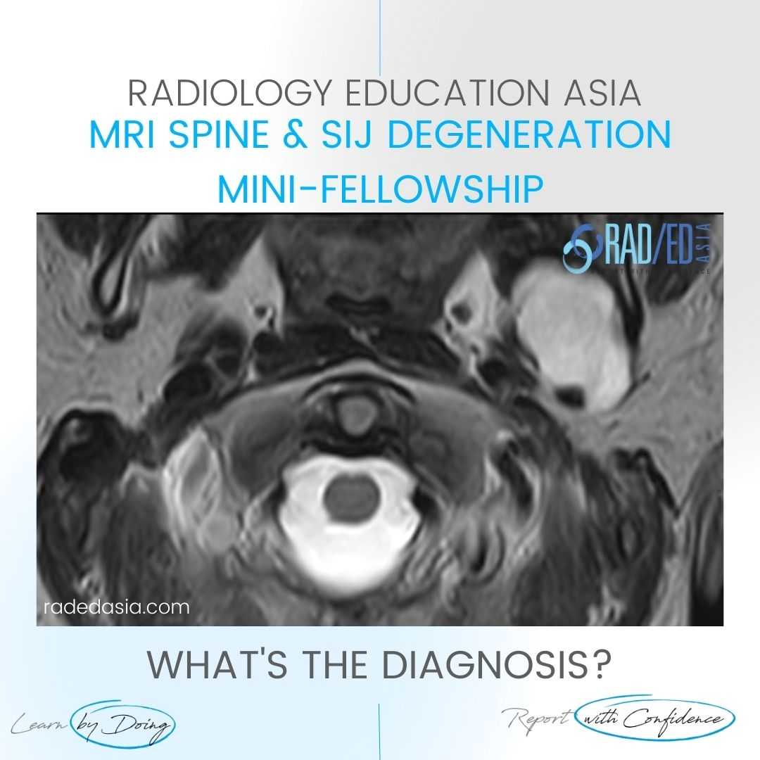 spine mri incidental findings parotid mass