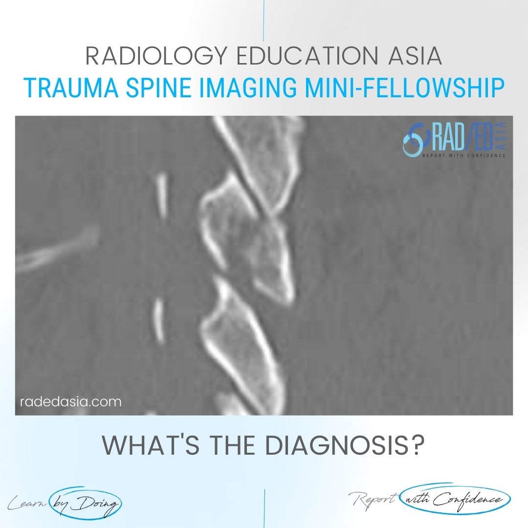 spine trauma imaging facet fracture dislocation radiology ct