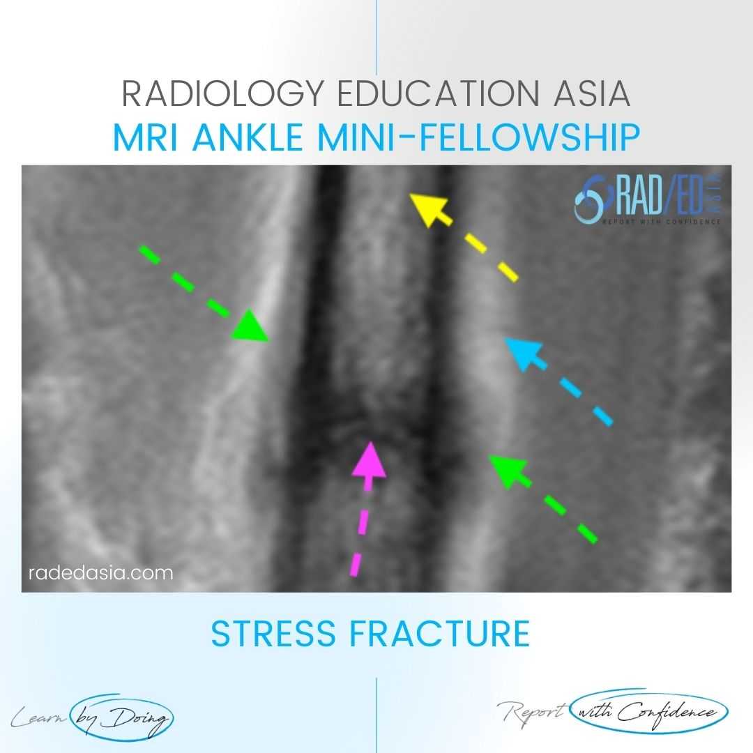 stress fracture fibula shin mri radiology periosteal xray radedasia