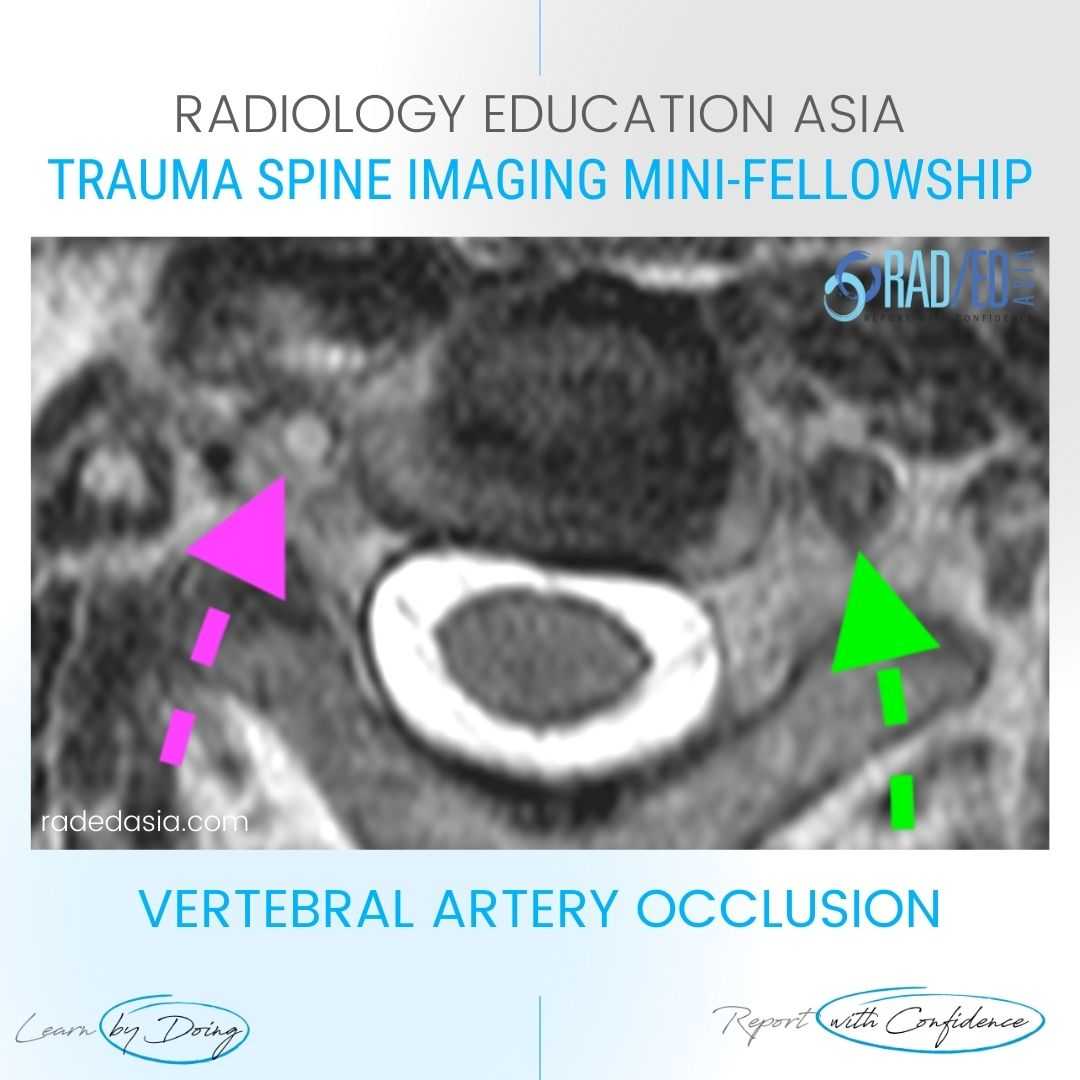 vertebral artery dissection mri radiology diagnosis