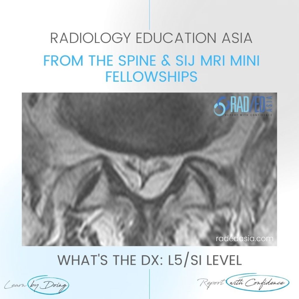 epidural lipomatosis radiology mri