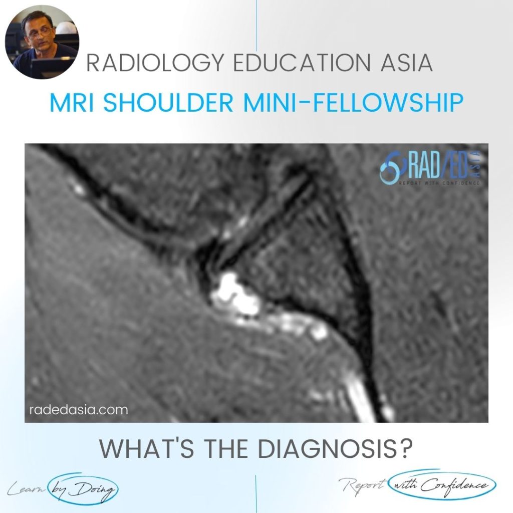 shoulder labrum paralabral cyst labrum mri radedasia