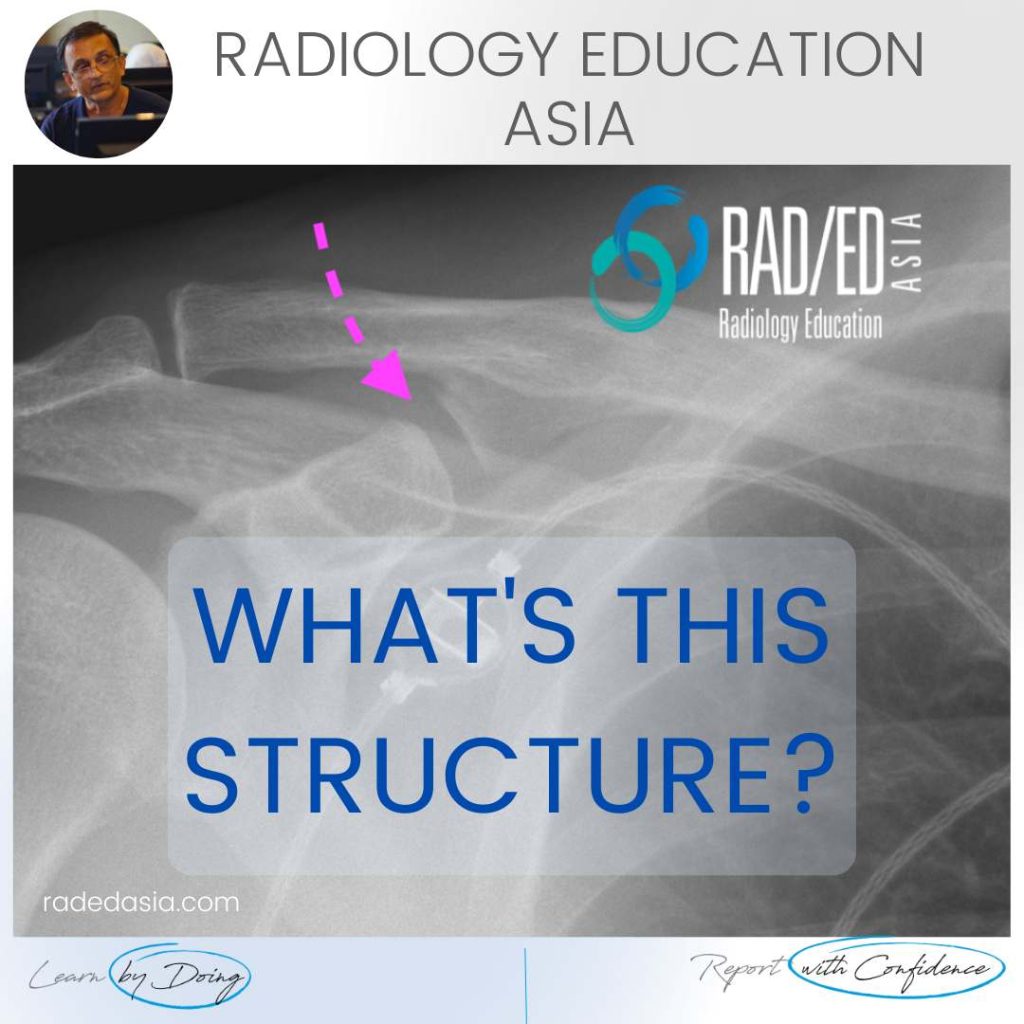 coracoclavicular joint shoulder normal variant xray radedasia