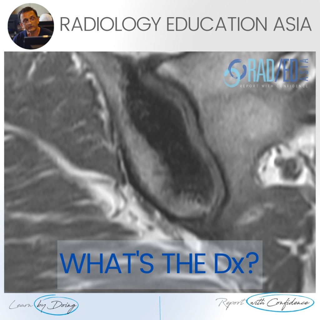 osteitis condensans illii mri spine radiology