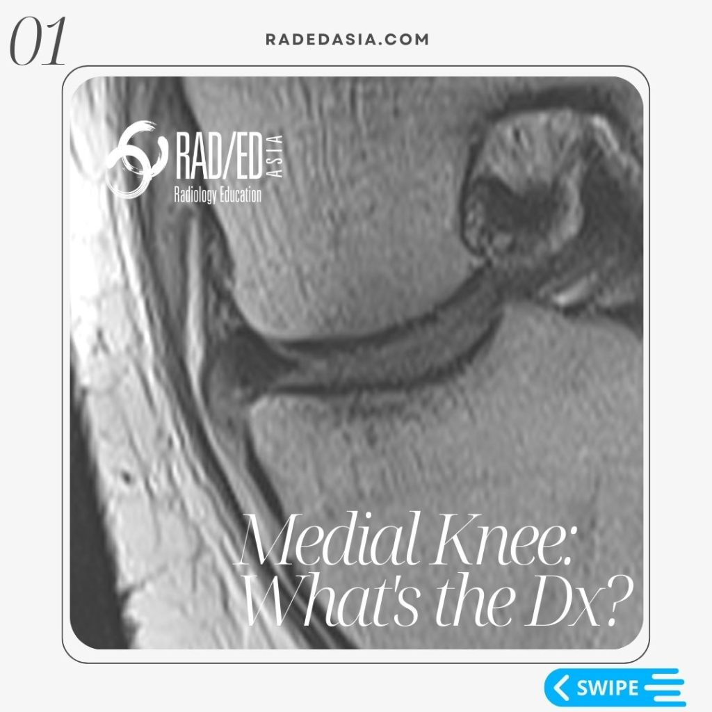 knee mri deep mcl meniscotibial ligament tear dmcl radiology