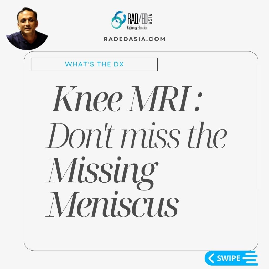 meniscal tear radiology mri knee radedasia