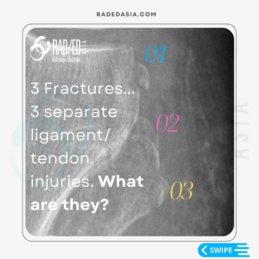 radiology knee segond arcuate lateral fibular fracture xray mri knee radedasia