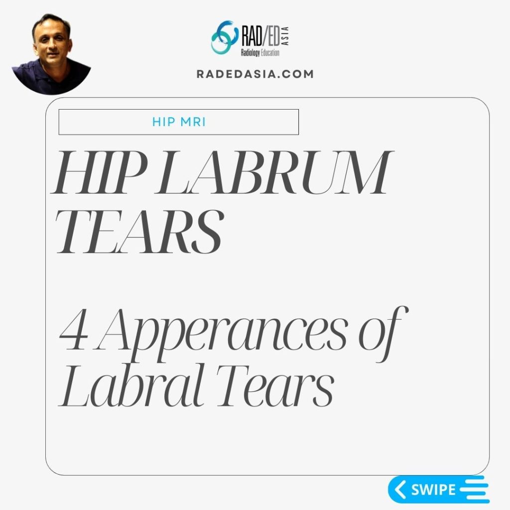 hip labrum labral tear paralabral cyst mri radiology