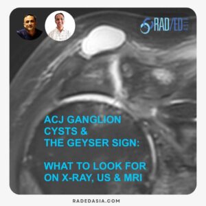 Geyser Sign ACJ ganglion Cyst shoulder mri x-ray ultrasound radedasia