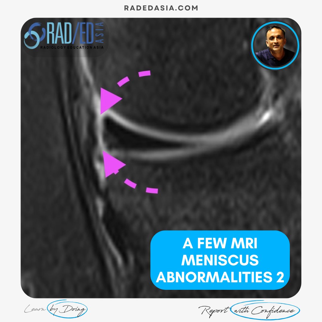 mri knee meniscus degeneration maceration flap tear extrusion meniscocapsular separation radedasia