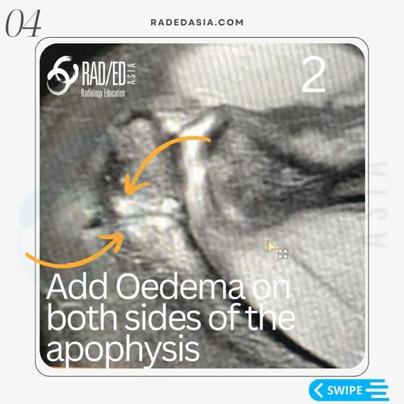 acromial apophysiolysis apophysitis os acromiale mri shoulder radiology