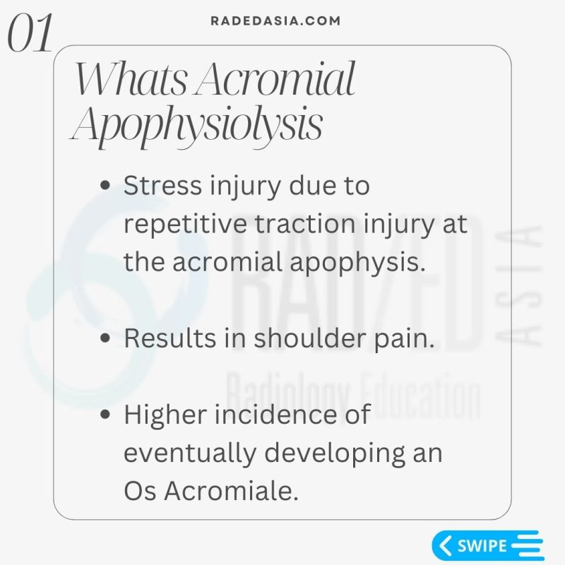 acromial apophysitis apophysiolysis os acromiale radiology mri shoulder