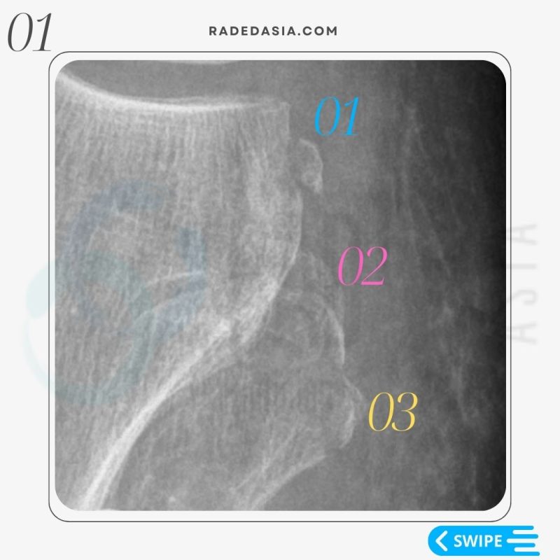 arcuate segond lateral fibular fracture xray mri knee