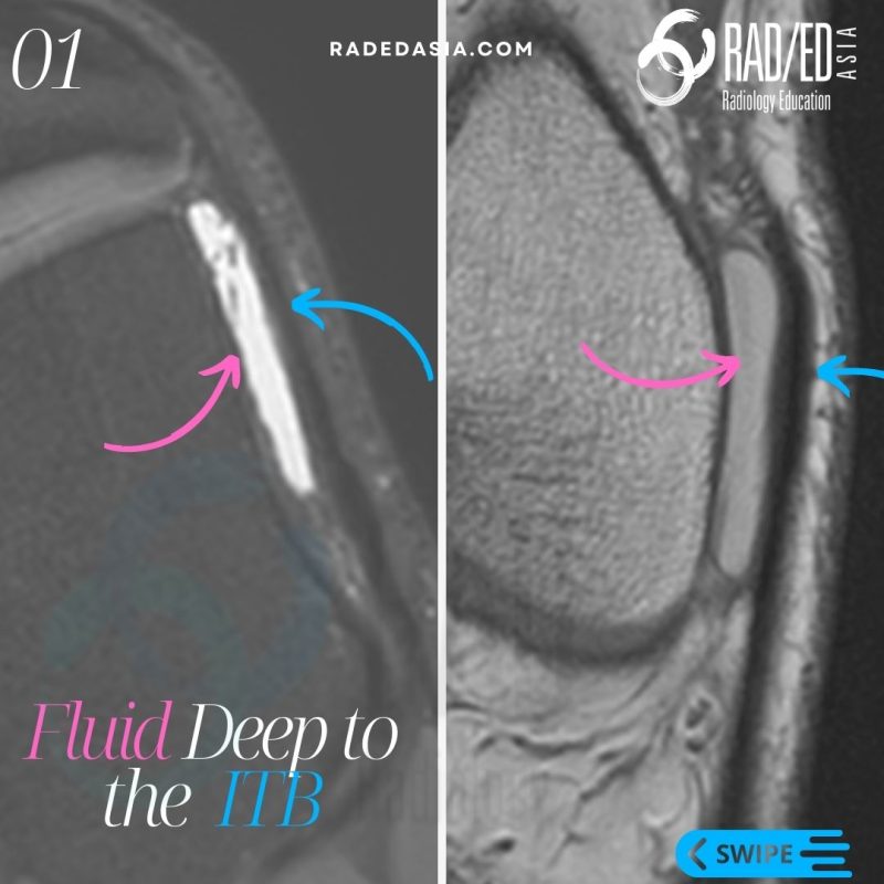 iliotibial itb band friction syndrome bursa radiology mri knee