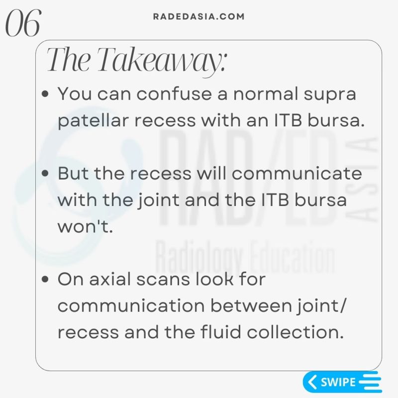 itb iliotibial band bursa mri friction syndrome radiology knee