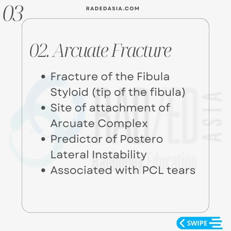 knee lateral fibular segond arcuate fracture xray mri