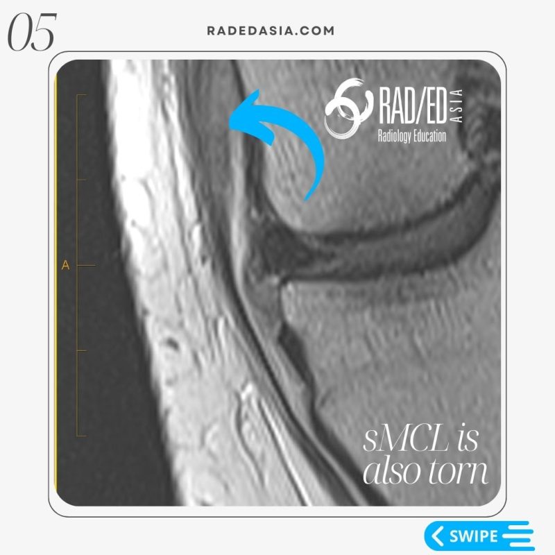 knee mri deep mcl meniscotibial ligament tear smcl