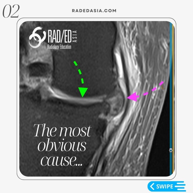 knee mri msk meniscus extrusion root tear