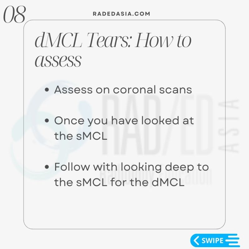 knee mri msk musculoskeletal deep mcl meniscotibial ligament tear dmcl