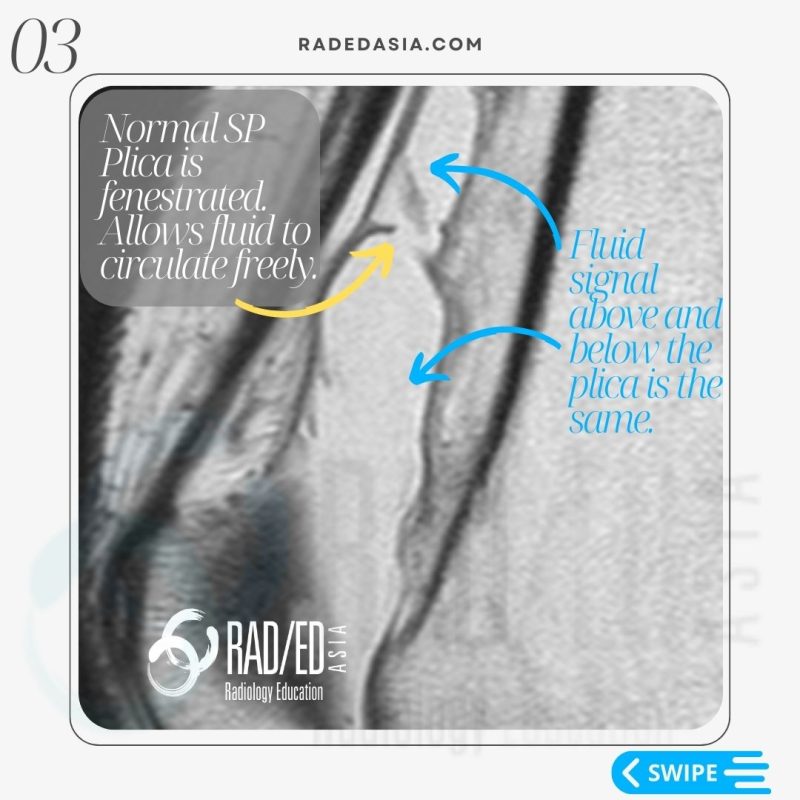 knee mri plica suprapatellar bursa lipohemarthrosis