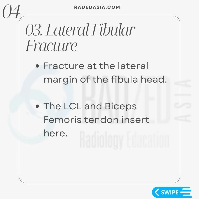 knee segond lateral fibular arcuate fracture xray mri