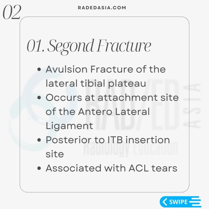 lateral fibular segond arcuate fracture xray mri knee