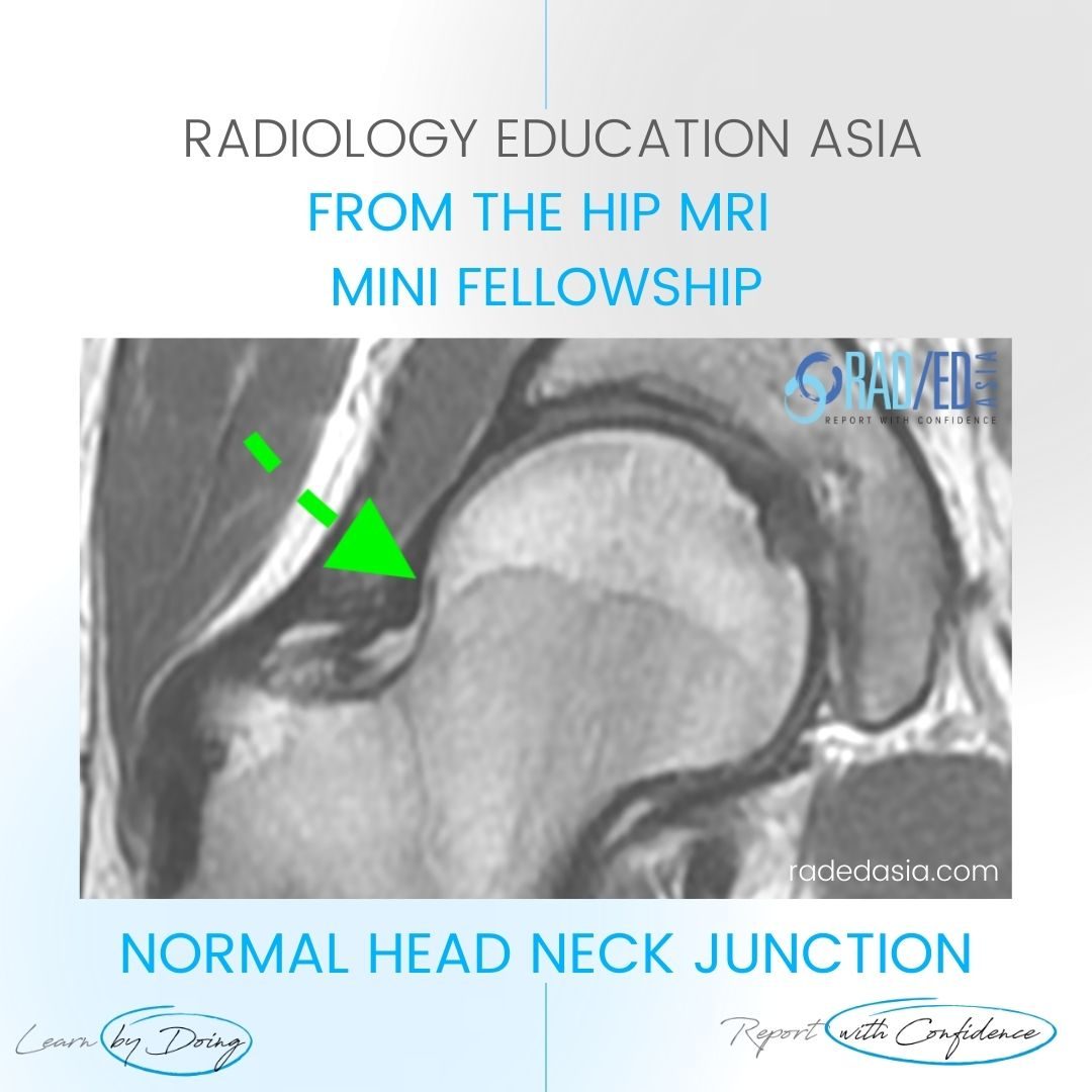 learn hip mri cam deformity normal head neck jn dx radedasia