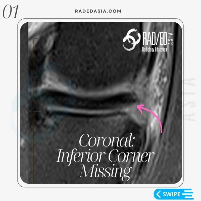 meniscal tear radiology mri knee coronal inferior radedasia