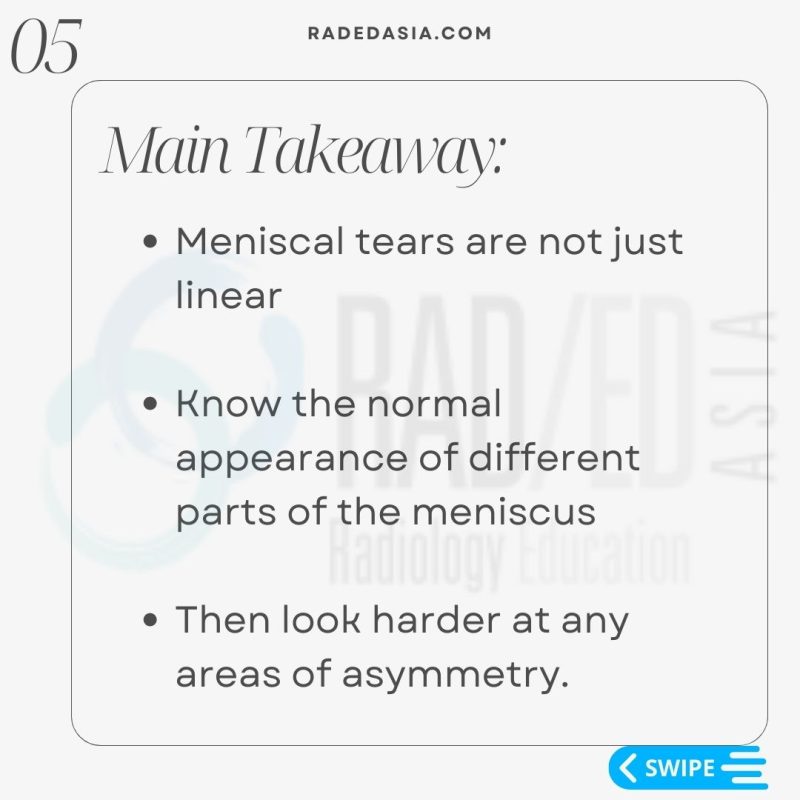 meniscal tear radiology mri knee dx radedasia