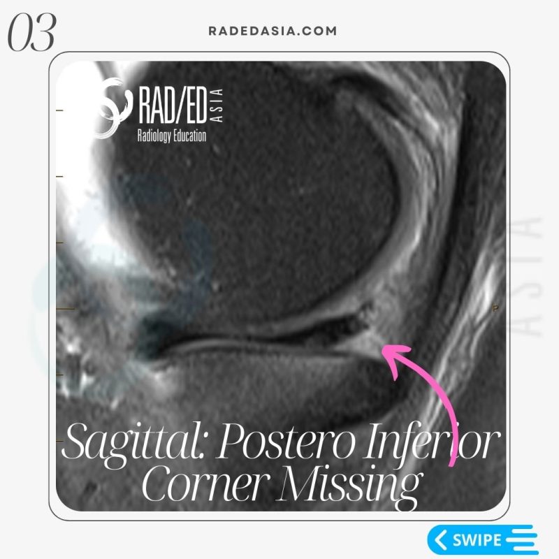 meniscal tear radiology mri knee sagittal posterior radedasia