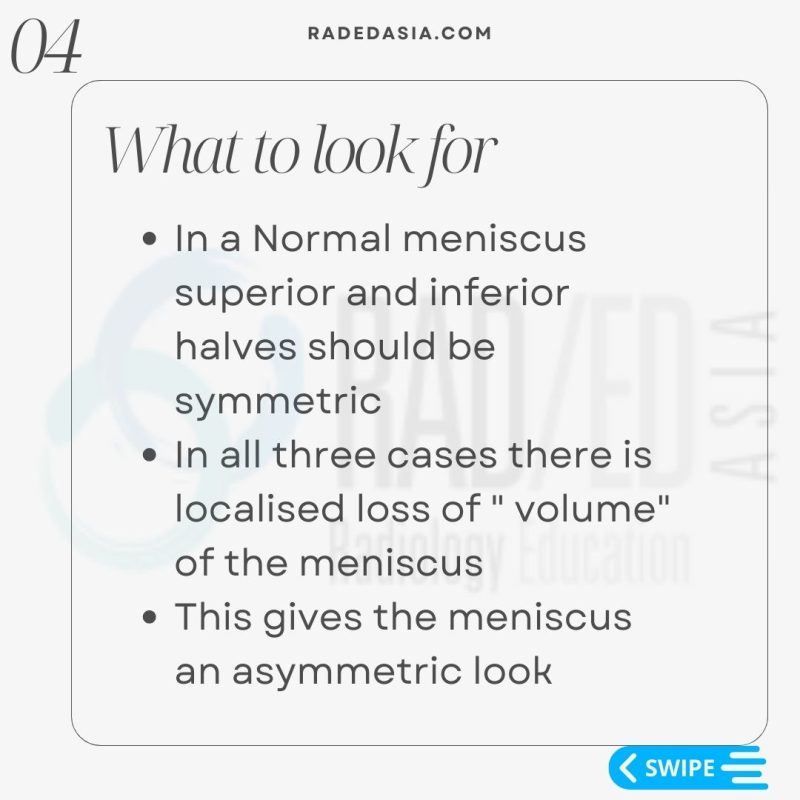 meniscal tear radiology mri knee what to look for radedasia