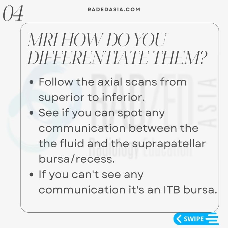 mri itb iliotibial band friction syndrome bursa radiology knee