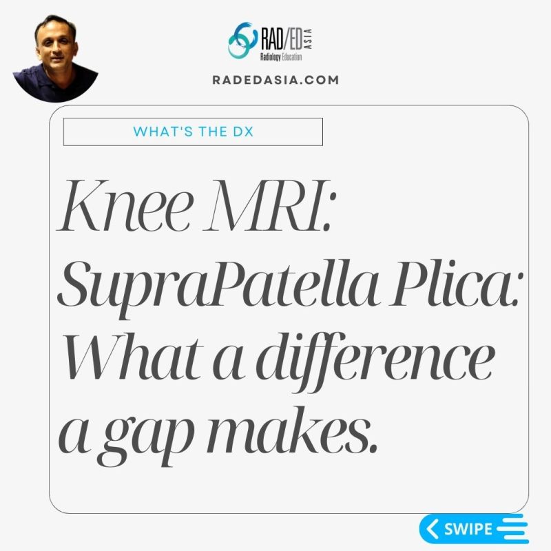 mri knee bursa suprapatellar plica