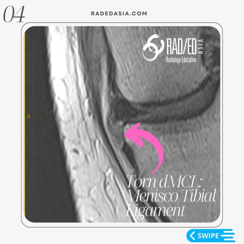 mri knee msk musculoskeletal deep mcl meniscotibial ligament tear dmcl radiology