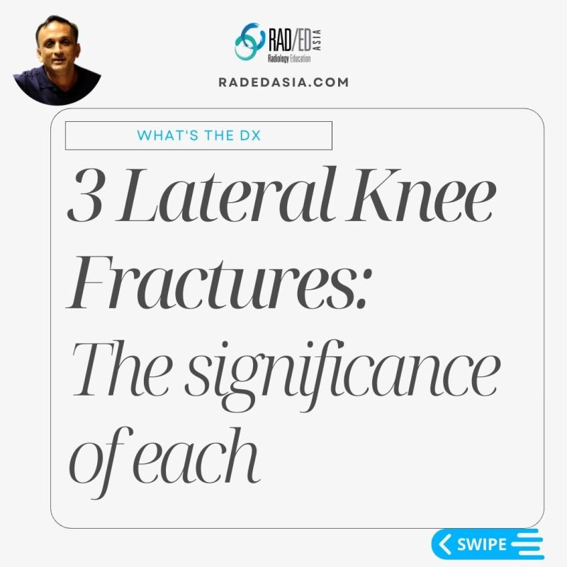 segond arcuate lateral fibular fracture xray mri knee radedasia