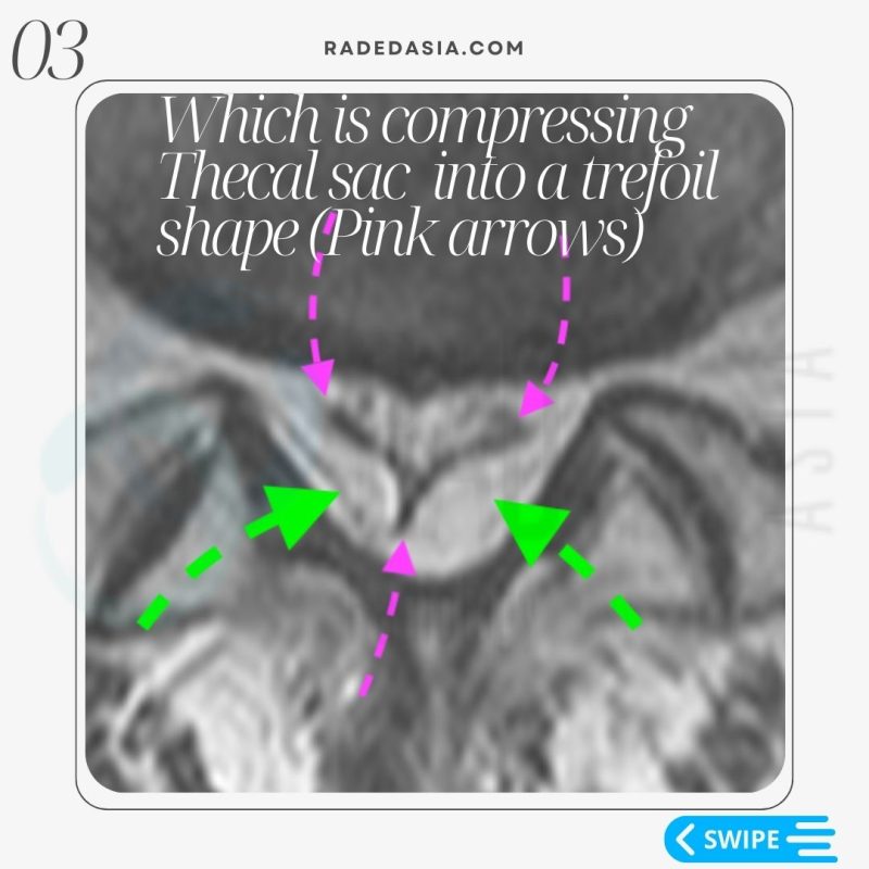 spine epidural lipomatosis lumbar mri radiology sac thecal radedasia