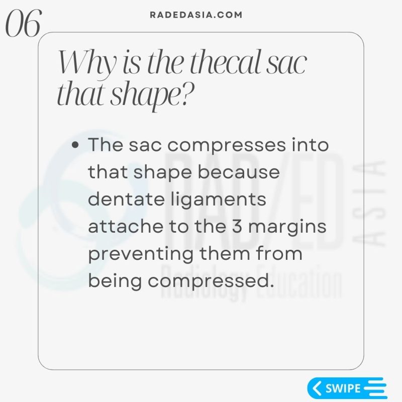 spine epidural lipomatosis lumbar mri radiology thecal sac