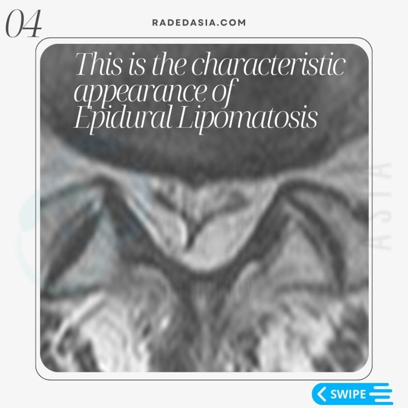 spine epidural lipomatosis lumbar mri radiology thecal sac radedasia