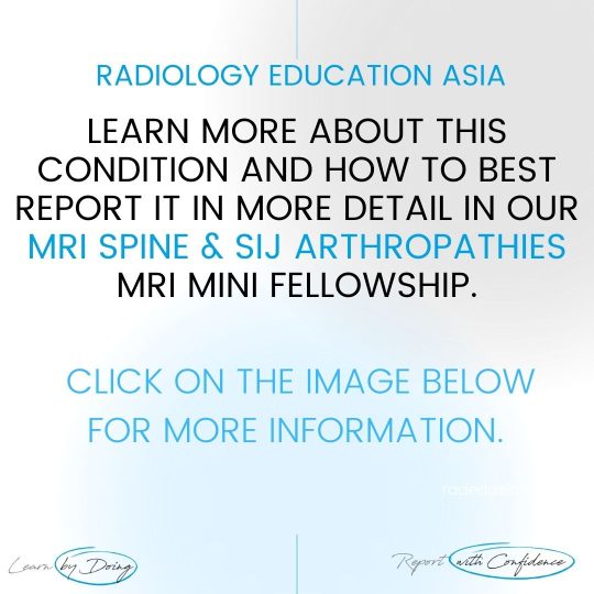 spine sij arthropathies mri learn radiology online course radedasia