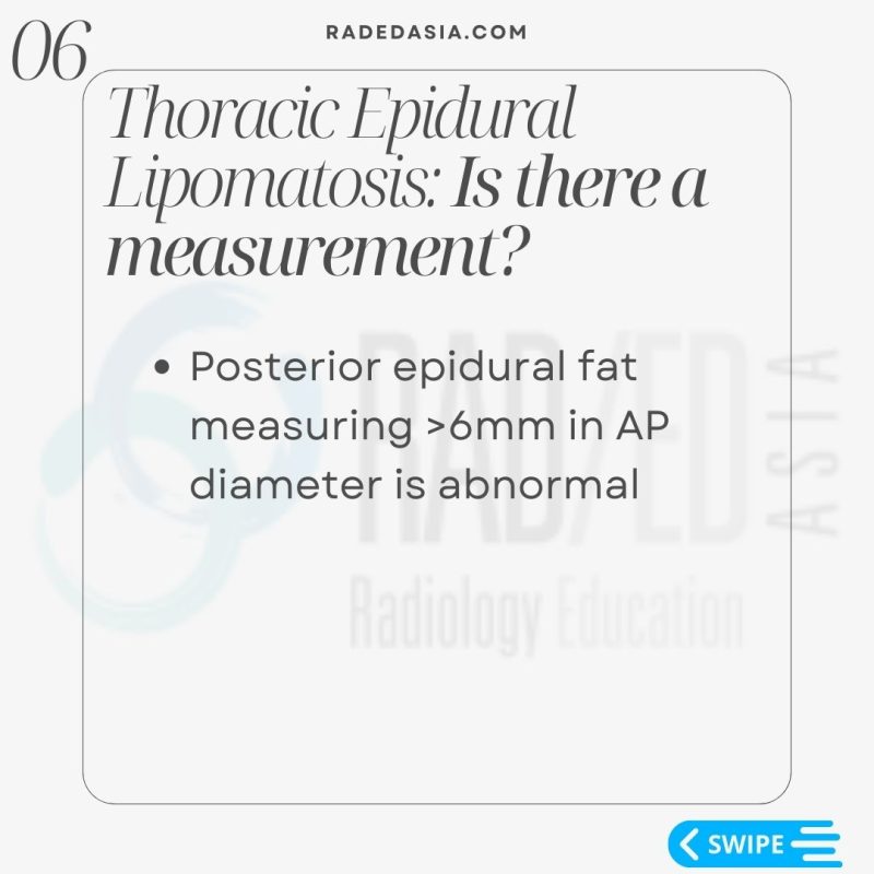 thoracic-epidural-lipomatosis- radiology-spinal-spine-mri-radedasia