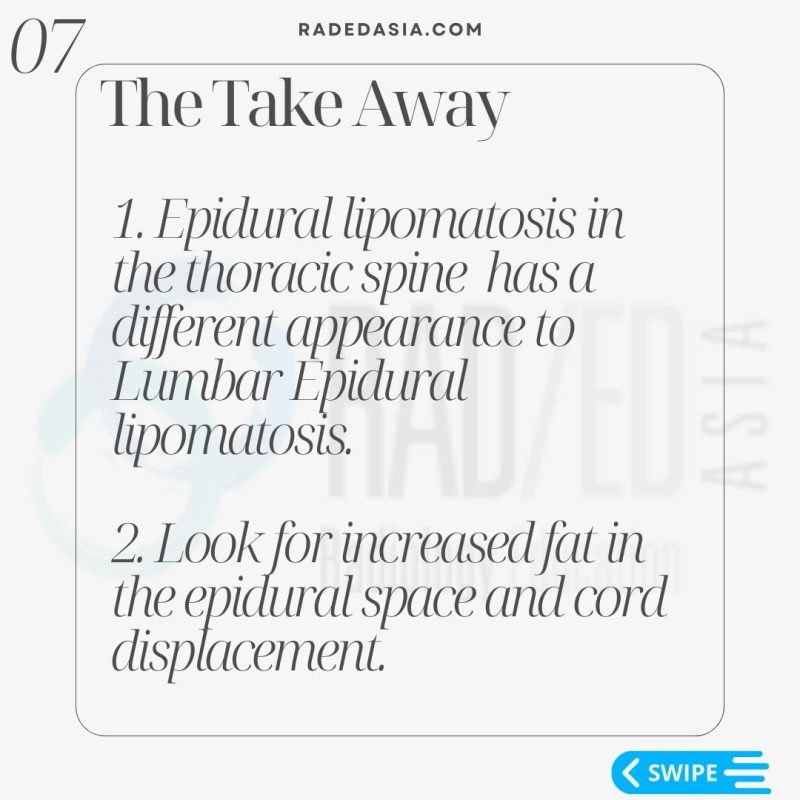 thoracic-epidural-lipomatosis- radiology-spine-spinal-mri