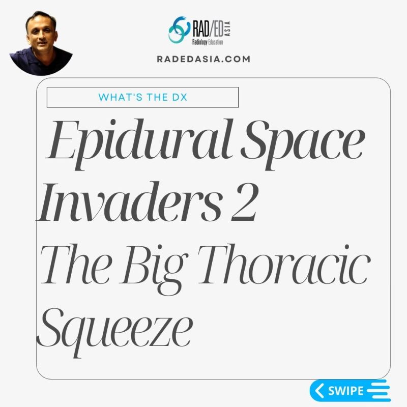 thoracic-epidural-lipomatosis-spinal-spine-radiology-mri-radedasia